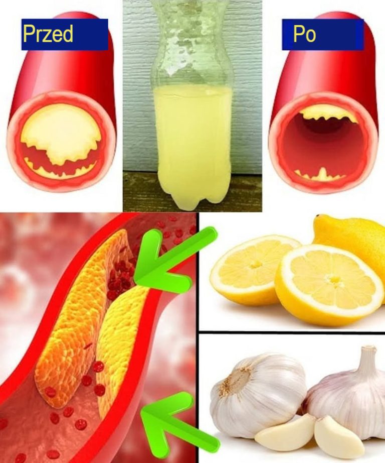Czosnek i Cytryna: Naturalna Moc Przeciwko Złemu Cholesterolowi i 10 Innych Problemów Zdrowotnych!
