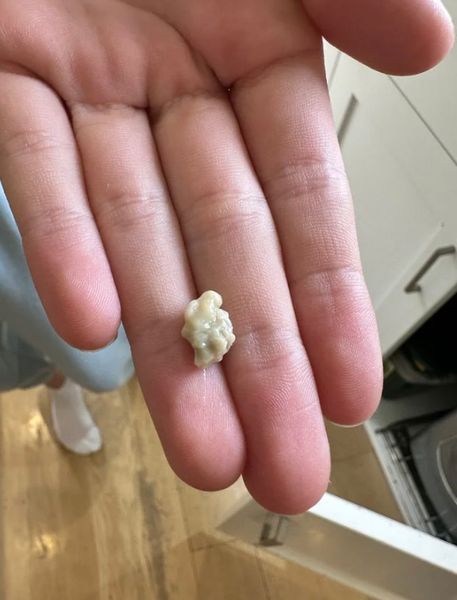 Oto, Co Musisz Wiedzieć o Kamieniach Migdałkowych – Dziwnych Naroślach Przypominających Pryszcze w Gardle