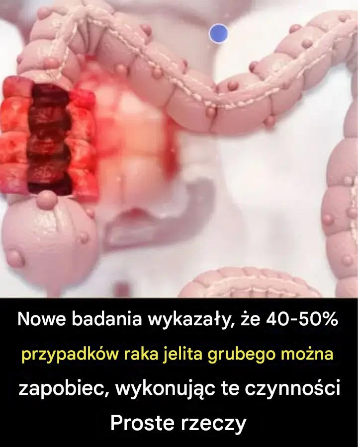 Nowe badanie wykazało, że 40–50% przypadków raka jelita grubego można zapobiec, wykonując te proste czynności