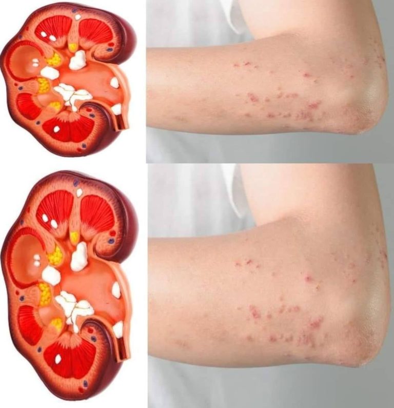 Jeśli Twoje nerki są w niebezpieczeństwie, Twój organizm wyśle ​​Ci 8 sygnałów!