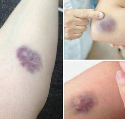 Niewyjaśnione siniaki? Oto, co Twoje ciało może próbować Ci powiedzieć