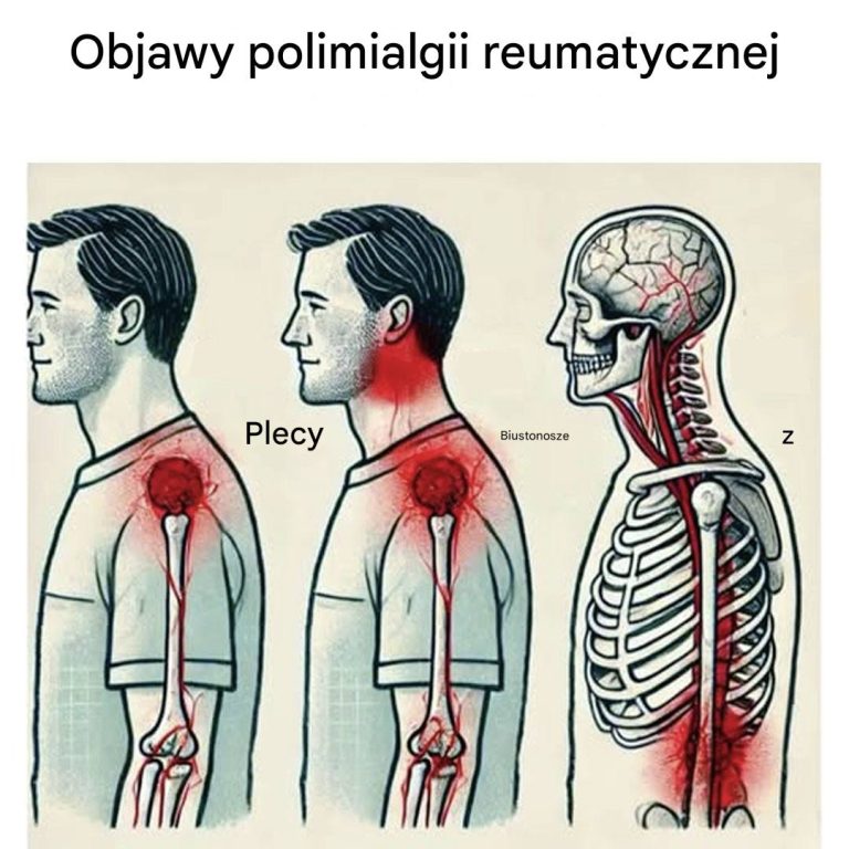 Objawy, na które należy zwrócić uwagę, mogące sugerować, że cierpisz na polimialgię reumatyczną