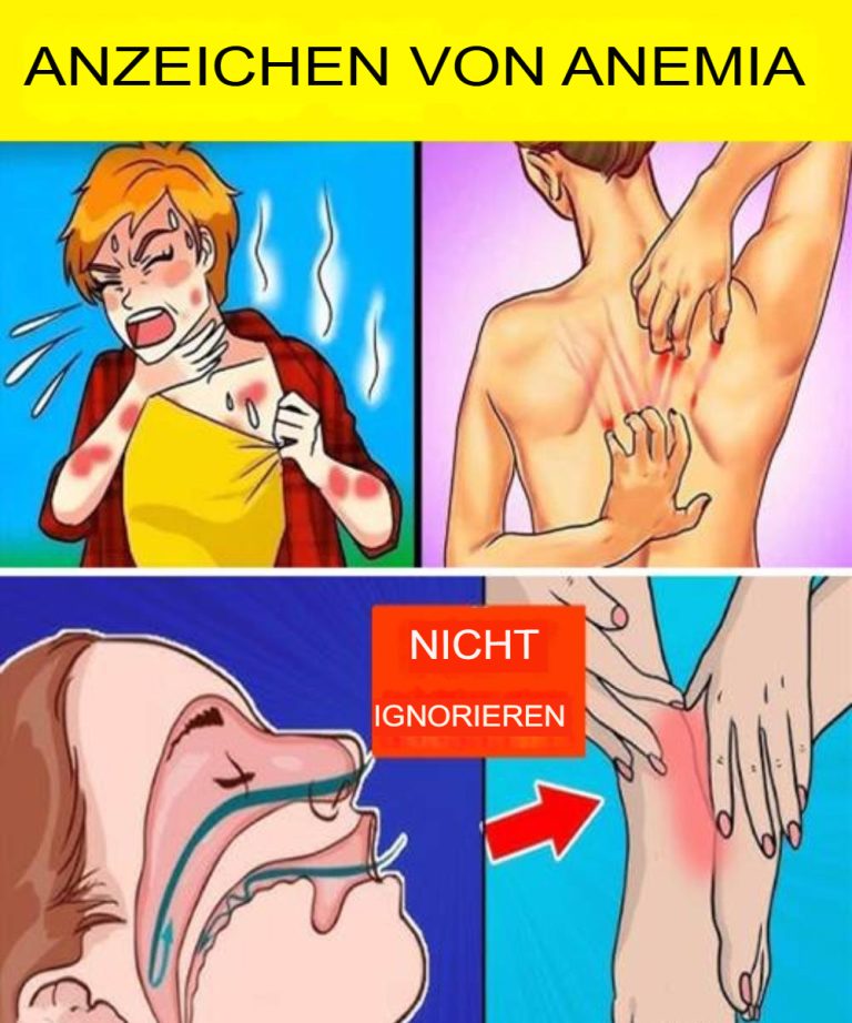 15 cichych objawów anemii, których nie należy ignorować