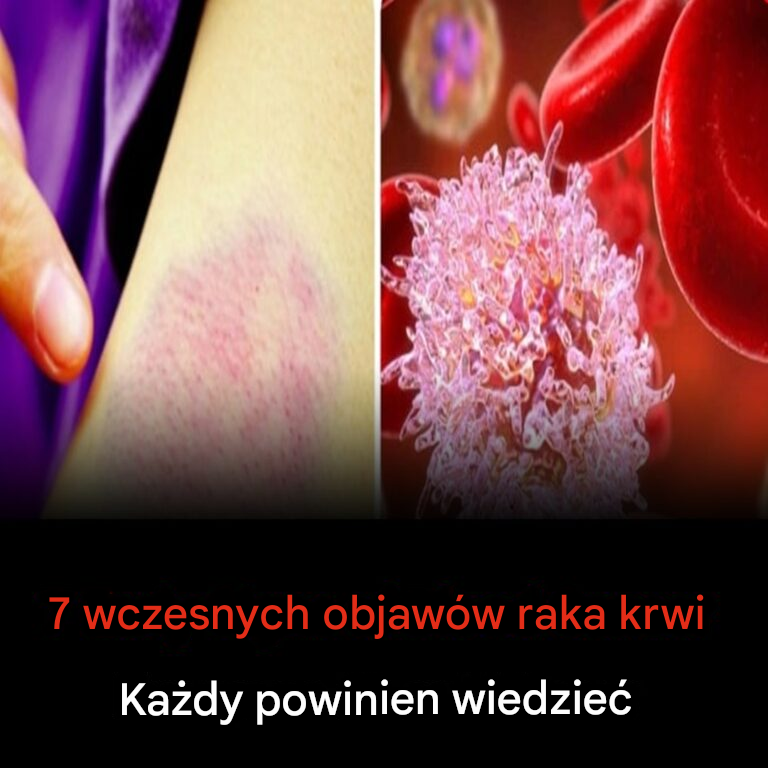 7 wczesnych objawów raka krwi, które każdy powinien znać