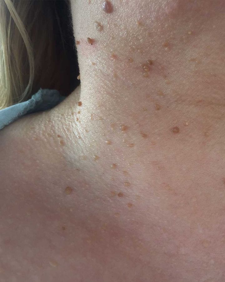 Jakie są najlepsze naturalne metody usuwania znamion ze skóry?