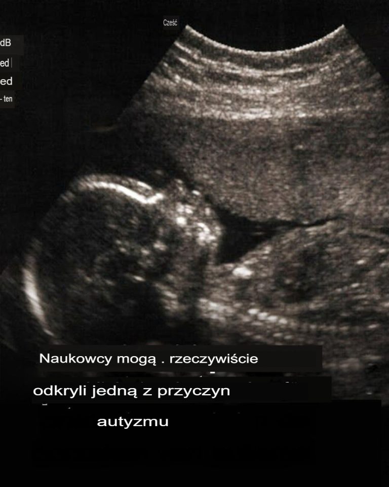 A co jeśli autyzm pozostawia niewidoczny ślad od urodzenia?