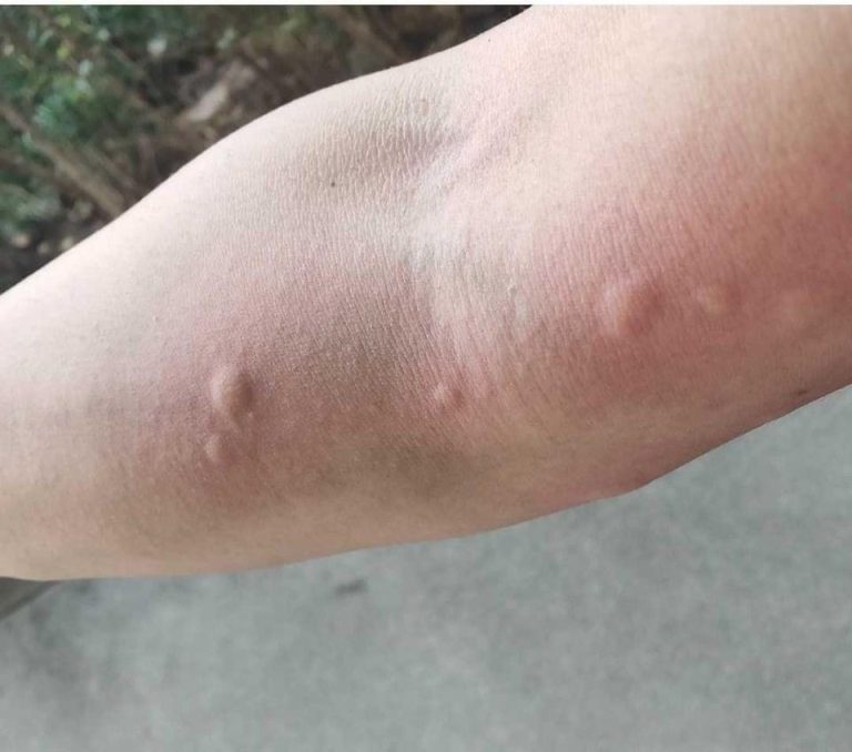 Mój tata nauczył mnie tej sztuczki, która pozwala powstrzymać ukąszenia komarów w zaledwie 1 minutę i nie powoduje żadnych efektów. Oto jak to działa