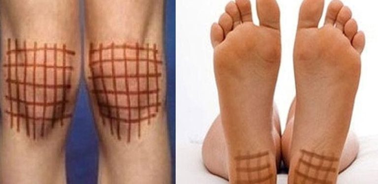 Pozbądź się różnych chorób stawów i chorób sezonowych nacierając kolana, klatkę piersiową, plecy i pięty jodem!