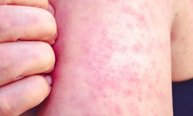 Czerwone kropki na skórze: rozszyfrowywanie ich znaczenia i implikacji