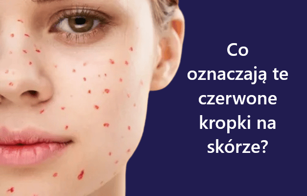 Co oznaczają te czerwone kropki na skórze?