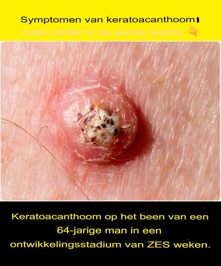 Objawy keratoacanthoma