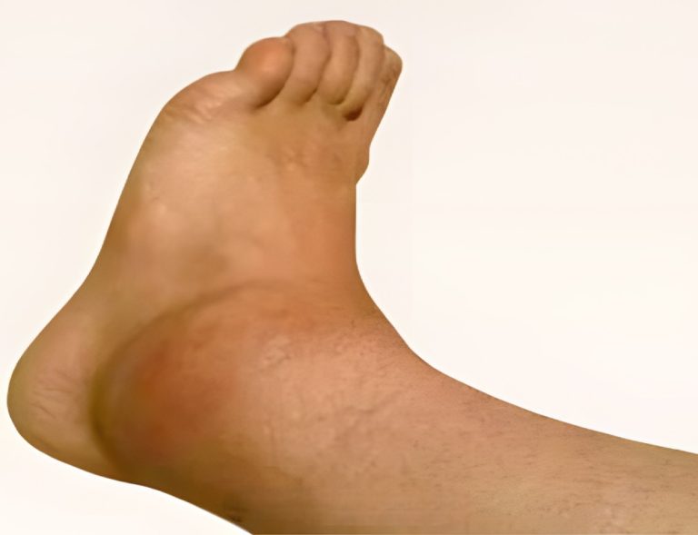 Obrzęk kostek i stóp wyjaśniony: ujawniono jego przyczyny!