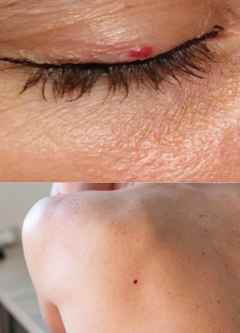 Masz czerwone plamy na ciele? Wiedz, że to objaw Tuzhilin!