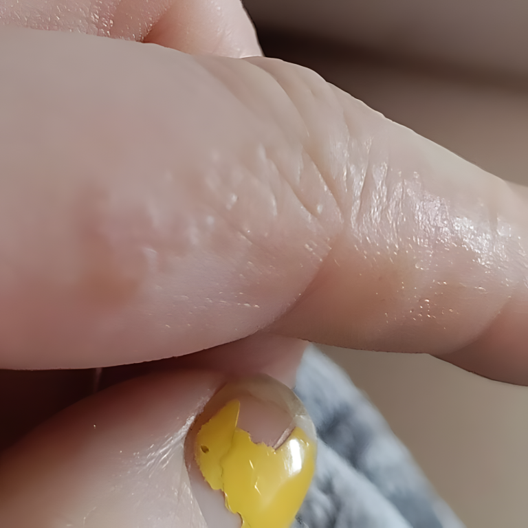 To są te małe, swędzące grudki na twoich palcach