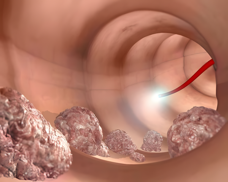 5 nietypowych objawów raka jelita grubego, które wiele osób przypadkowo ignoruje przez lata