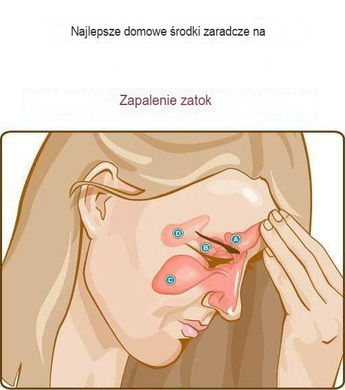 Najlepsze domowe sposoby leczenia zapalenia zatok
