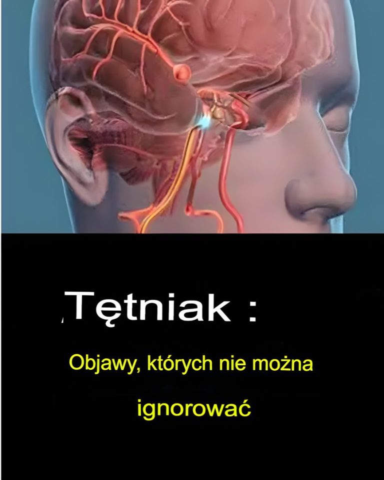 Tętniak mózgu – objawy, których nie wolno ignorować