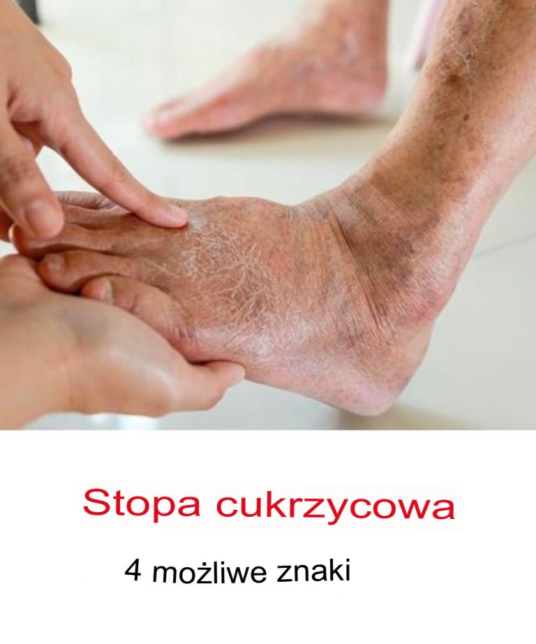 Stopa cukrzycowa: czym jest i jak leczyć jedno z najpoważniejszych powikłań cukrzycy