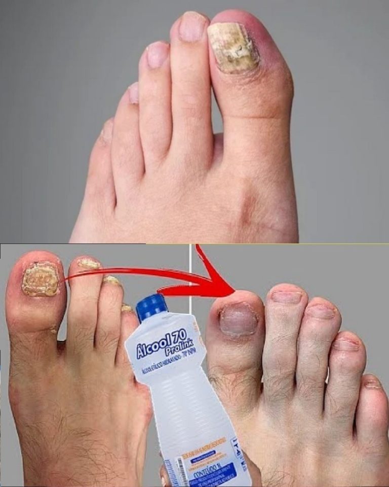 Infuzja i sen! Dowiedziałem się tego, czekając w kolejce w SUS (Narodowej Służbie Zdrowia), cierpiąc od 20 lat z powodu zgniłego gwoździa.