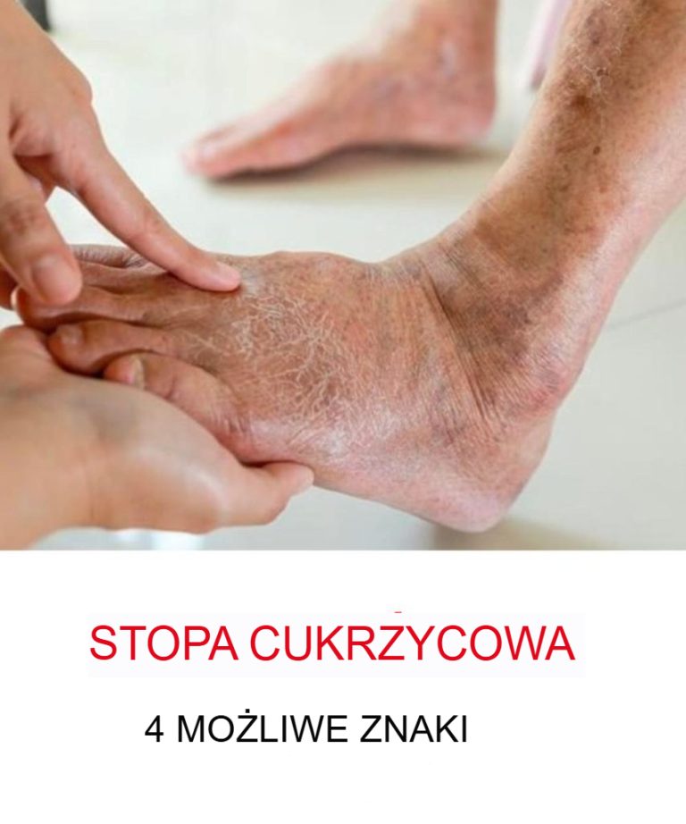 Stopa cukrzycowa: czym jest i jak leczyć jedno z najpoważniejszych powikłań cukrzycy