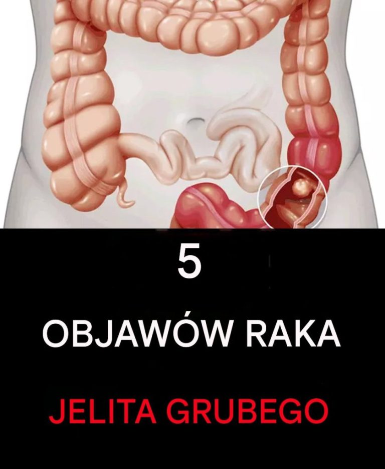 5 oznak raka jelita grubego