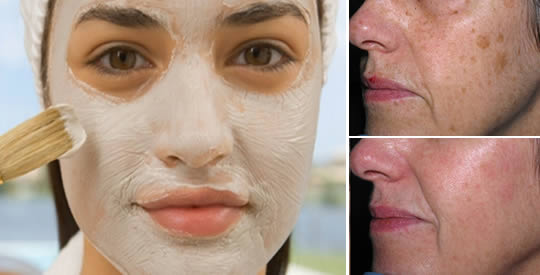 Maseczka z sody oczyszczonej i octu, która na zawsze usuwa plamy, zmarszczki i trądzik