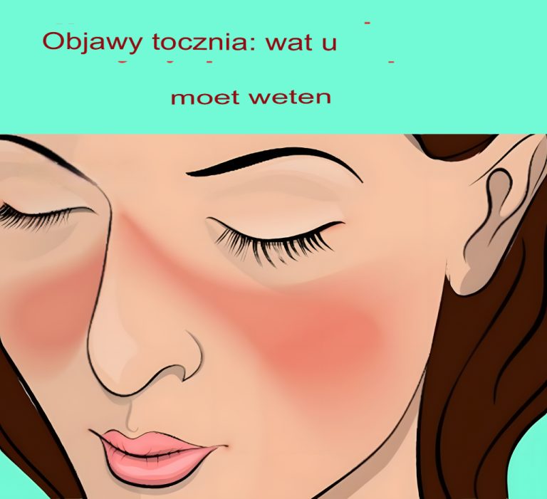 Wczesne objawy tocznia: co musisz wiedzieć