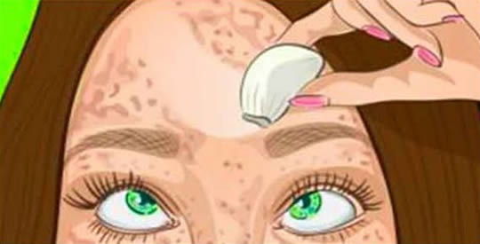 Niedoskonałości skóry: jak pozbyć się ich naturalnie w kilka minut