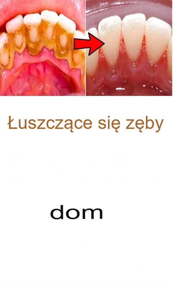 7 naturalnych sposobów na odkamienianie i wybielanie zębów w domu!