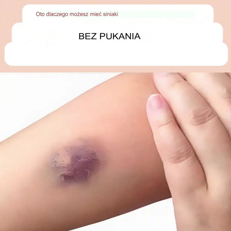 Dlatego powstają siniaki, nawet jeśli się nie uderzyłeś.