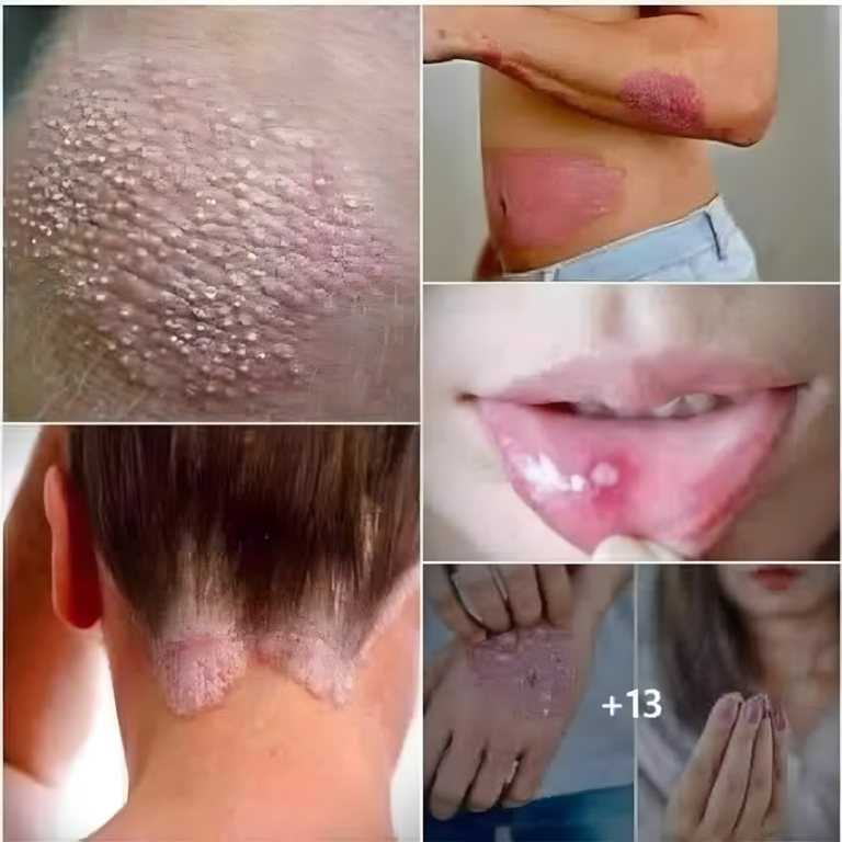 Rozpoznawanie objawów wirusa HPV: Co warto wiedzieć