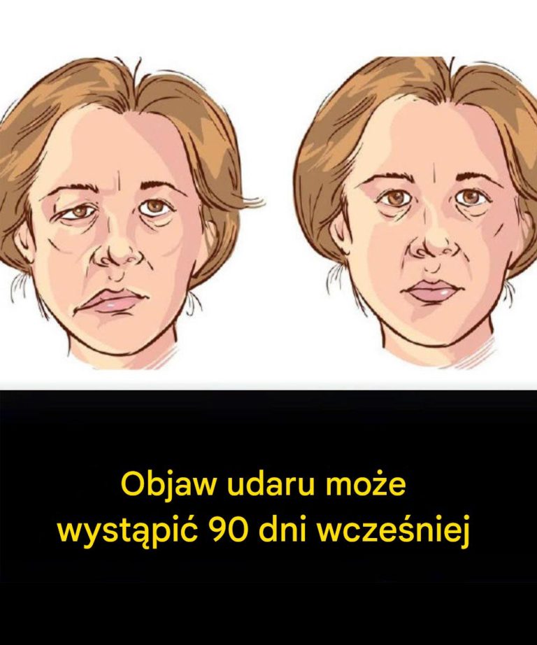 Objaw udaru może wystąpić 90 dni wcześniej