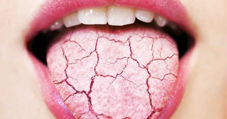 5 roślin na suchość w ustach