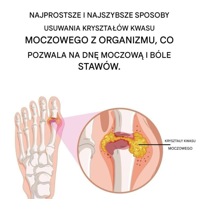 Jak naturalnie złagodzić dnę moczanową i ból stawów