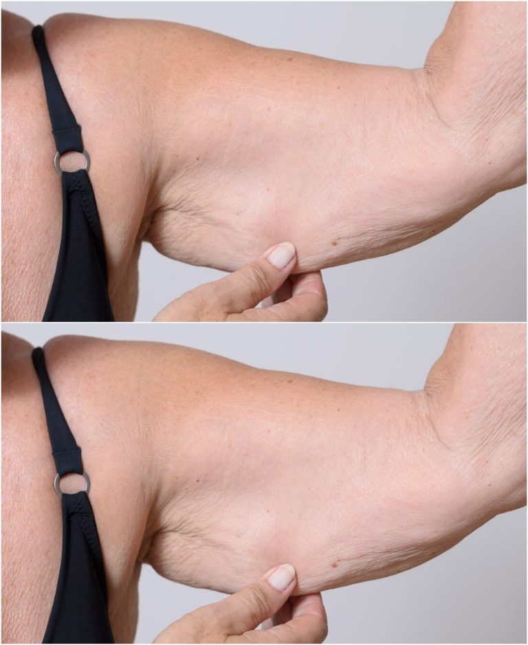 Słabość mięśni u osób starszych nazywa się sarkopenią. Jak uniknąć jego tragicznych konsekwencji?