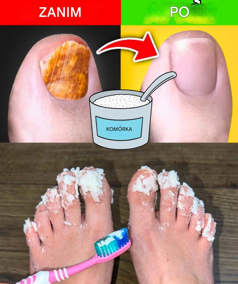 Jeśli masz grzyb paznokci, wypróbuj to naturalne lekarstwo
