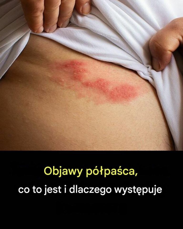 Wszystko, co musisz wiedzieć o półpaścu: przyczyny, wczesne wykrywanie i naturalne leczenie.